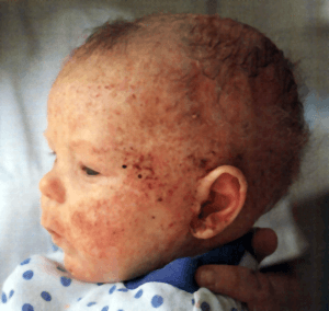 Niño con enfermedad cutánea